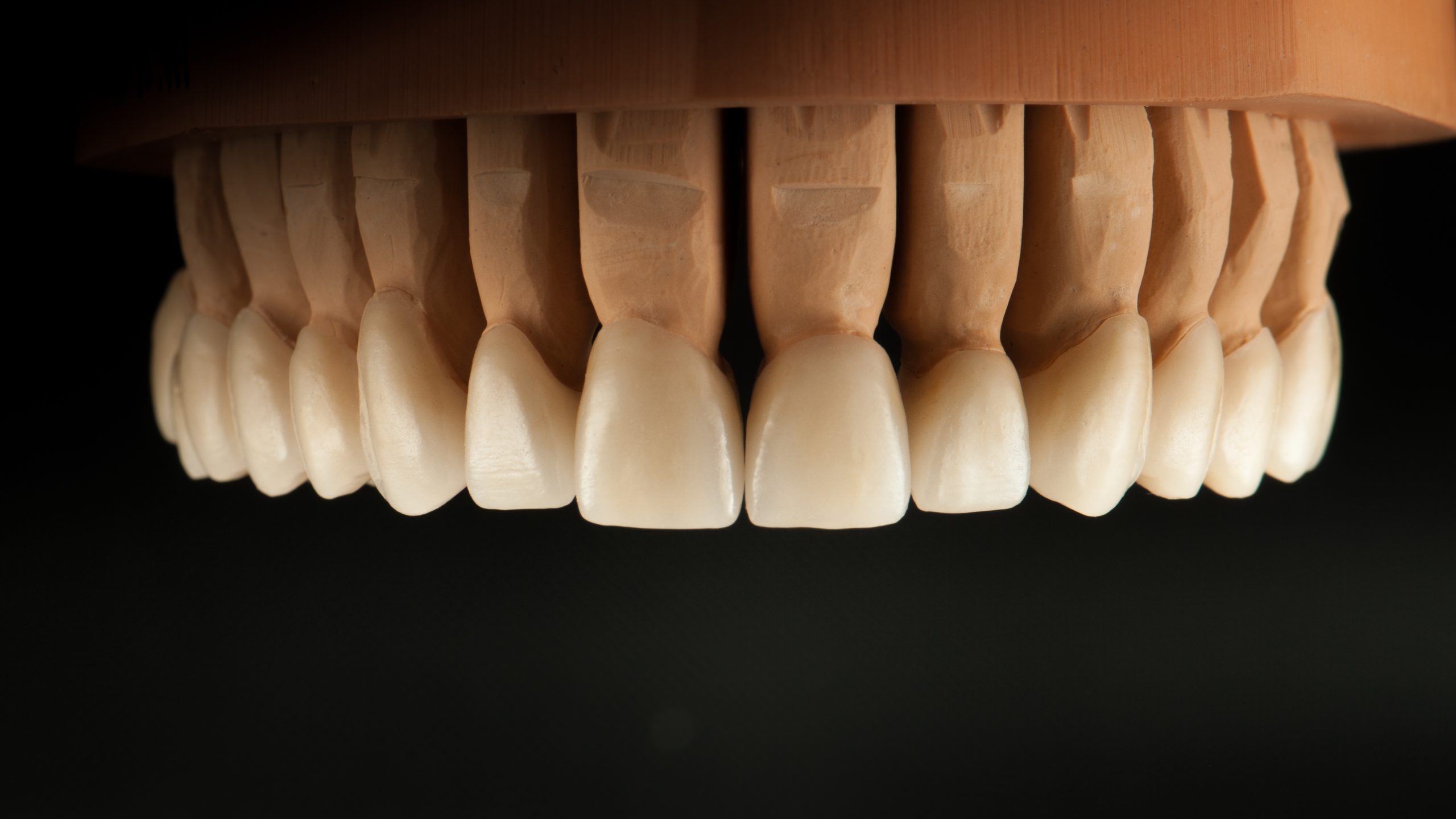 Ästhetische Zahnkronen aus Keramik